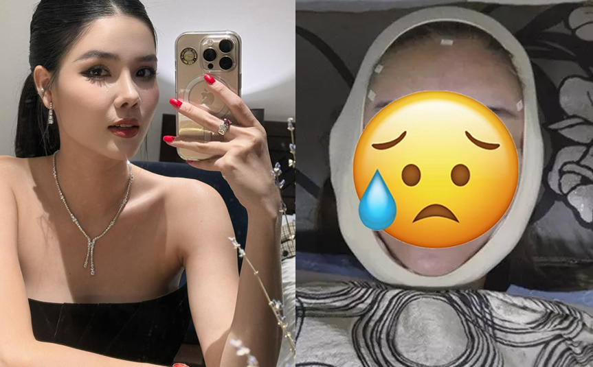 Người mẫu Việt tự đăng ảnh mặt sau thẩm mỹ, chính chủ cũng r:ùng mình: ‘Tôi tưởng không bao giờ dám soi gương nữa’