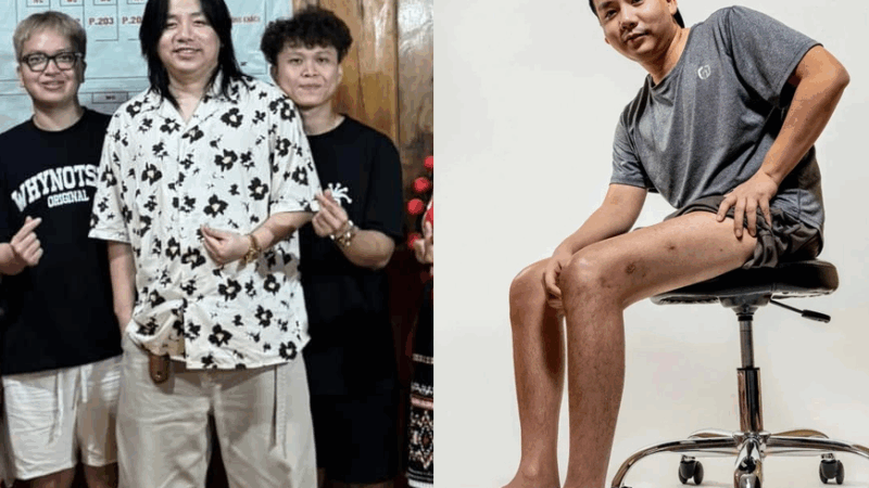 Sốc nặng ngoại hình ‘trên ngắn dưới dài’ của Khoa Pug sau 2 lần kéo chân: Người thường muốn bình thường, anh lại muốn thành khuyết tật?