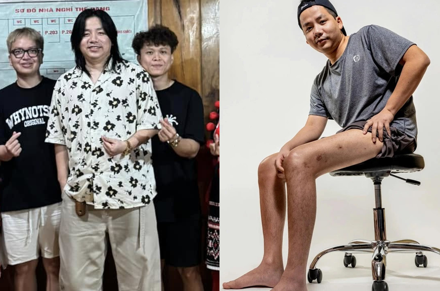 Sốc nặng ngoại hình ‘trên ngắn dưới dài’ của Khoa Pug sau 2 lần kéo chân: Người thường muốn bình thường, anh lại muốn thành khuyết tật?