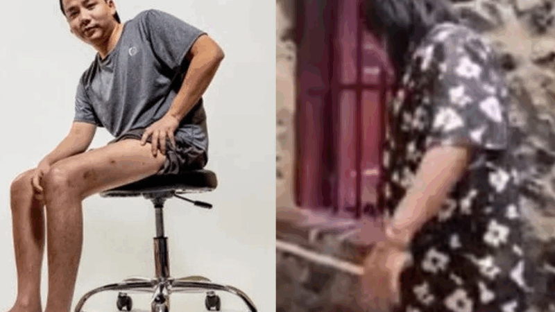 Sốc với dáng đi tập tễnh của Khoa Pug sau 2 lần kéo chân: Từ đại gia thành ‘người tật’ chỉ vì muốn cao thêm vài cm
