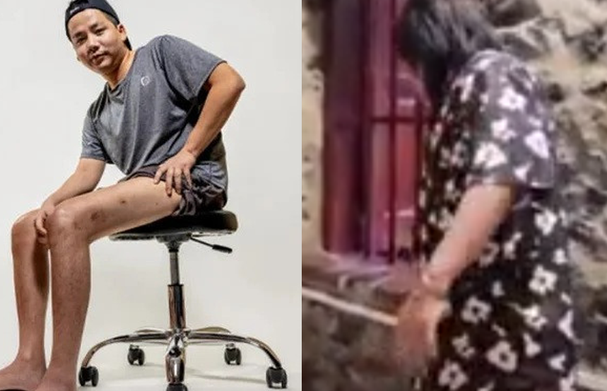 Sốc với dáng đi tập tễnh của Khoa Pug sau 2 lần kéo chân: Từ đại gia thành ‘người tật’ chỉ vì muốn cao thêm vài cm