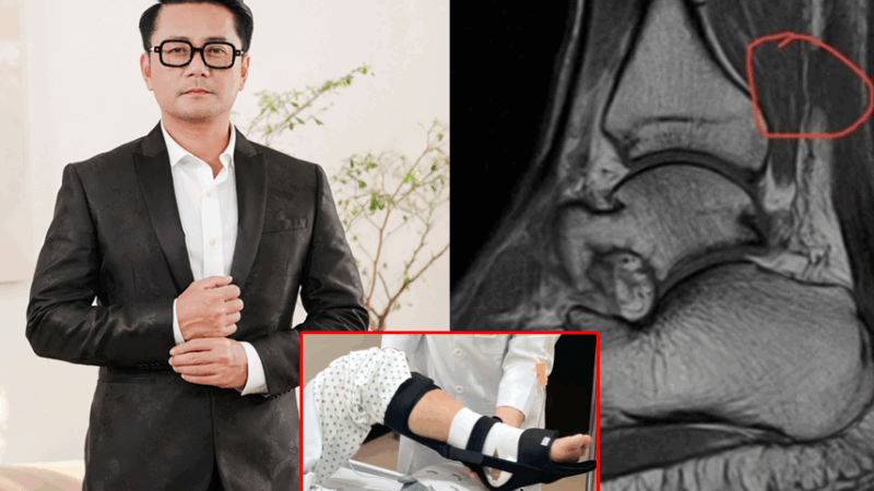 Diễn viên “Lật mặt 7” đứt gân gót chân khi chơi pickleball, dự kiến nằm giường 6 tháng