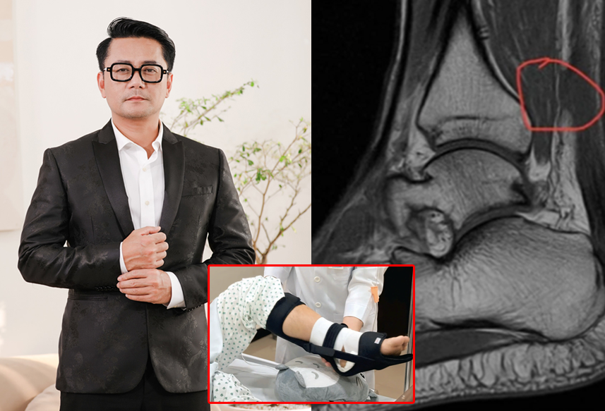 Diễn viên “Lật mặt 7” đứt gân gót chân khi chơi pickleball, dự kiến nằm giường 6 tháng