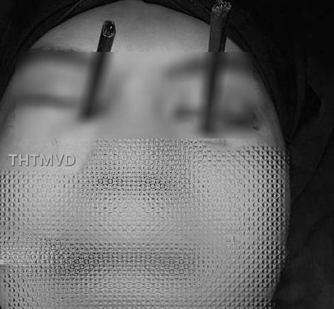 Nam thanh niên 25 tuổi gặp tai nạn hy hữu: 2 chiếc đũa đâm vào mắt cùng lúc, bác sĩ cũng hiếm khi chứng kiến!