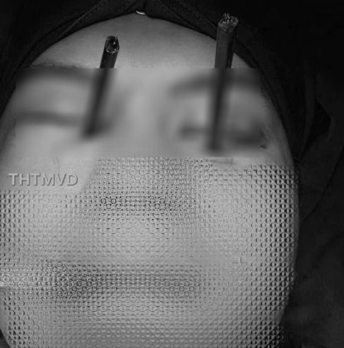 Nam thanh niên 25 tuổi gặp tai nạn hy hữu: 2 chiếc đũa đâm vào mắt cùng lúc, bác sĩ cũng hiếm khi chứng kiến!